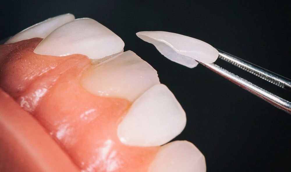 Ask a Dentist Are veneers better than dental crowns?