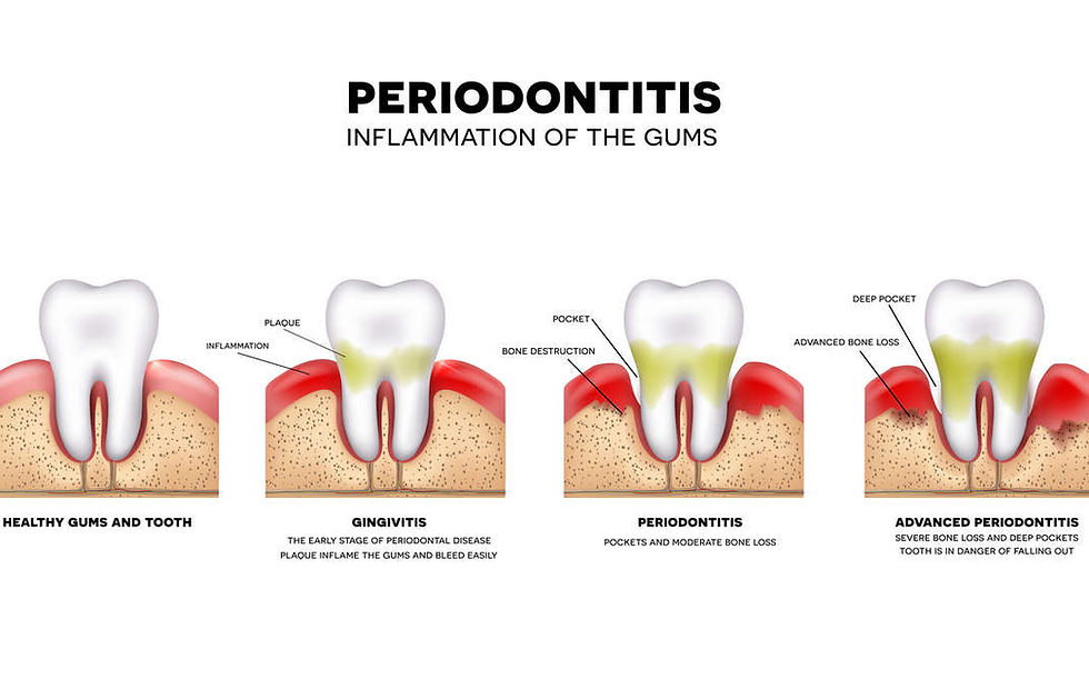 gum disease, periodontal disease, warren dentist, The Star Dental Group