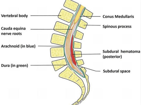 Overlooked Danger: The Missed Diagnosis of Spinal Hematoma