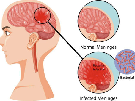 Every Second Counts : The High Stakes of Timely Intervention in Paediatric Meningitis
