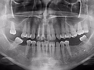 La importancia de la panorámica en el diagnóstico odontológico