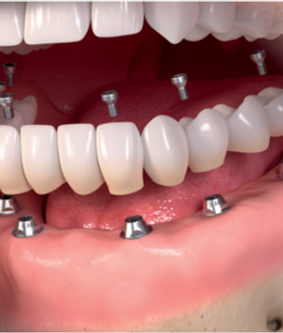 Implantes e Proteses