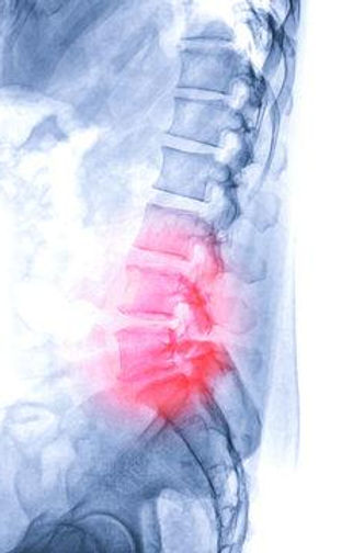X-ray image of lambosacral spine or L-S spine lateral view from patient lower back pain s