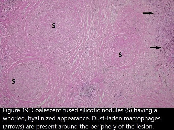 Pulmonary nodules (S)（Image source：CDC，CC0 1.0 ）
