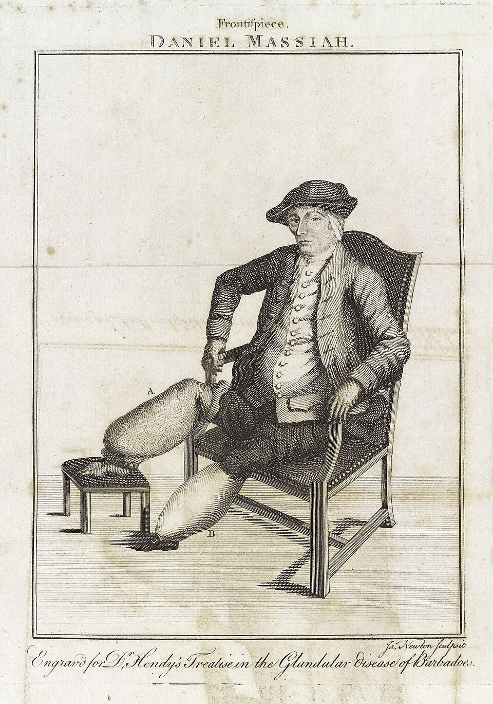 Elephantiasis: A Chronic Disease Linking Mosquitoes, Filarial Worms, and the Breakdown of the Lymphatic System