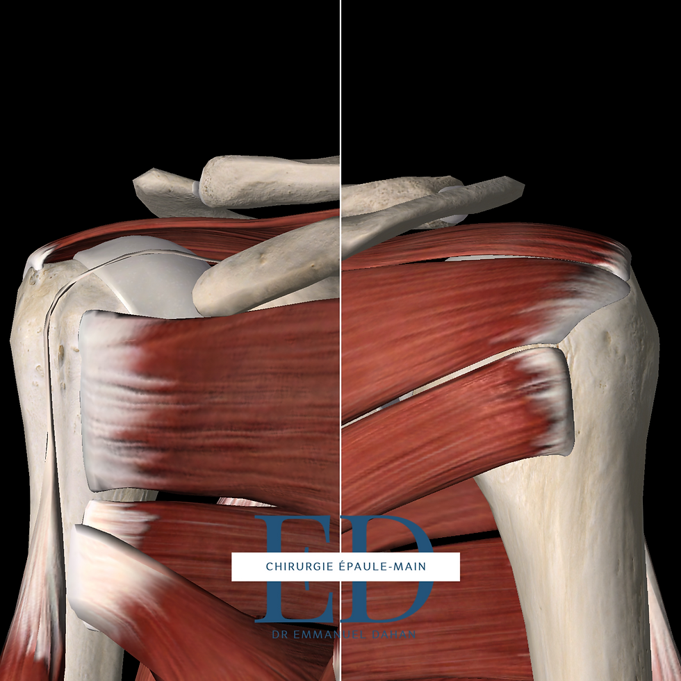 Tendons de la coiffe des rotateurs de l'épaule, chirurgie épaule paris, chirurgie des tendons de la coiffe des rotateurs paris 