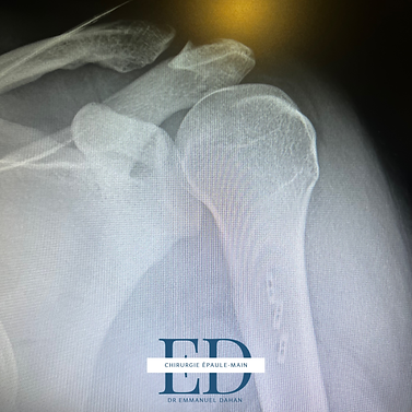 rupture du grand pectoral grand pectoral paris rupture tendon épaule rupture du grad pectoral chirurgie du grand pectoral paris Dr Dahan