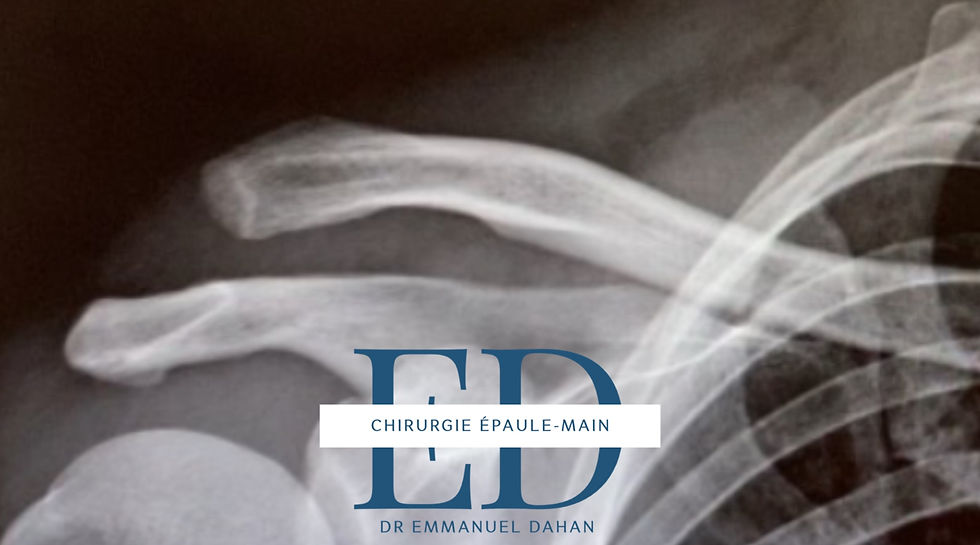 Disjonction acromio claviculaire de l'épaule, epaule du sportif , épaule paris , chirurgie de l'épaule paris