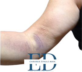 rupture biceps distal_edited.png