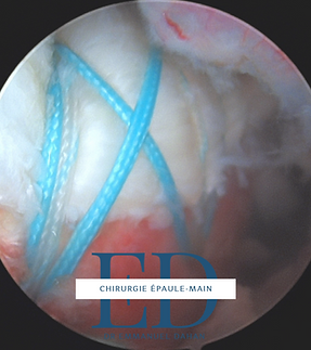 réparation coiffe des rotateurs epaule paris meilleur chirurgien epaule paris.PNG