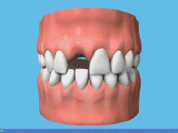 implants (1).gif