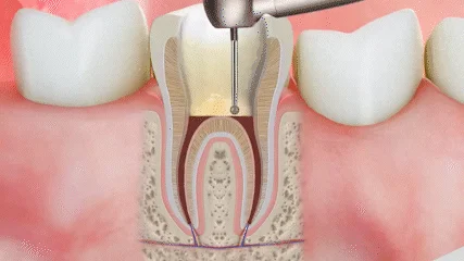 endo.webp