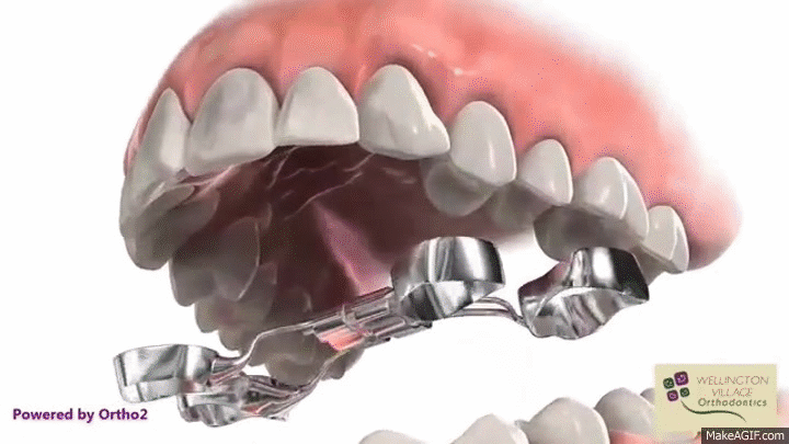 Hyrax_Appliance_Wellington_Village_Orthodontics.gif