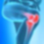 Preventing arthritis and bone disease despite mass fluoridation