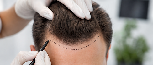 Hair transplantation