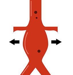 Abdominal Aort Anevrizmaları