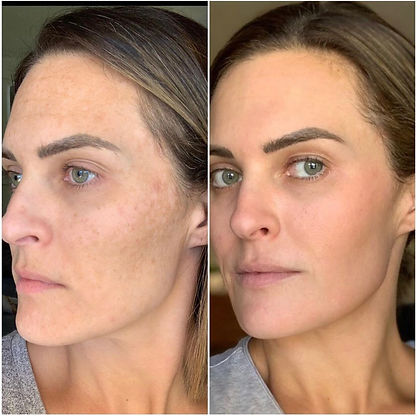 Cosmelan Peel.jpeg