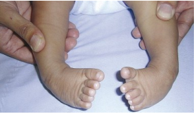 The Potential risks of PPROM To Your Baby’s Arms, Legs and Nervous System: A Doctor’s Perspective