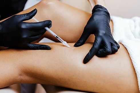 Sclerotherapy-Injections-during-a-Spider-Vein-Treatment-for-Legs-at-Glow-Dermspa-in-Lakewo