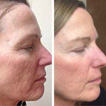 Before & After Six Microneedling with Exosomes 