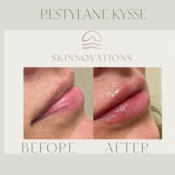Before & After Restylane Kysse