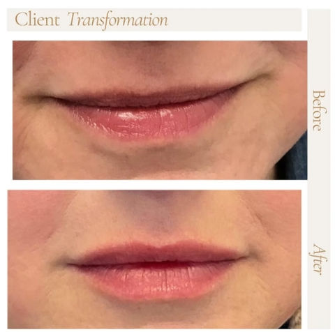 Before & After Juvéderm Volbella