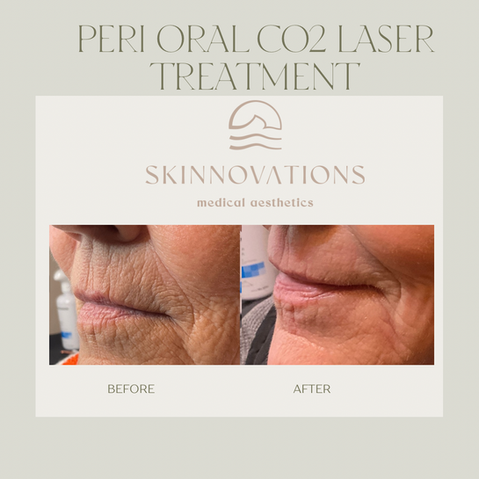 Before & After CO2 Laser 