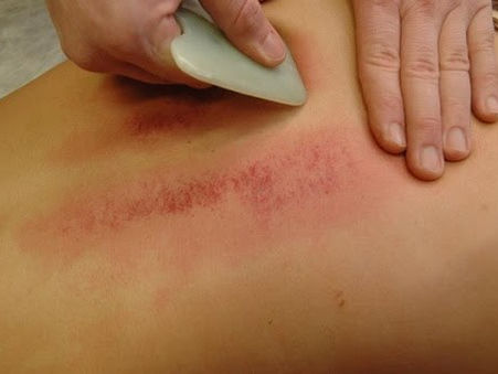 Qu'est le Gua Sha ?