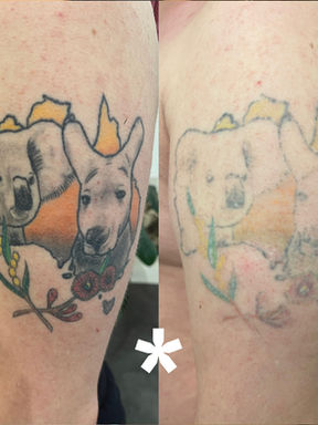 Koala- und Känguru-Tattoo am Oberarm vor Tattooentfernung / Koala- und Känguru-Tattoo am Oberarm nach Laser Tattooentfernung