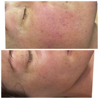 Before and after Korean clinical skincare treatment for sensitive red skin