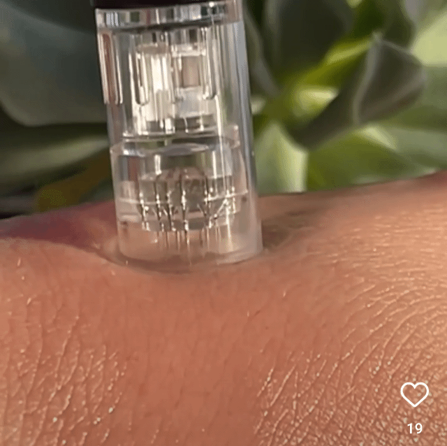 microneedling calgary nw