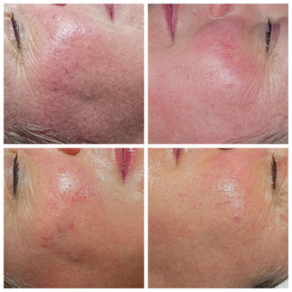 Before and after rosacea treatment results showing reduced redness