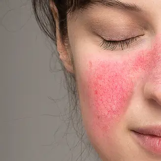 rosacea-calgary