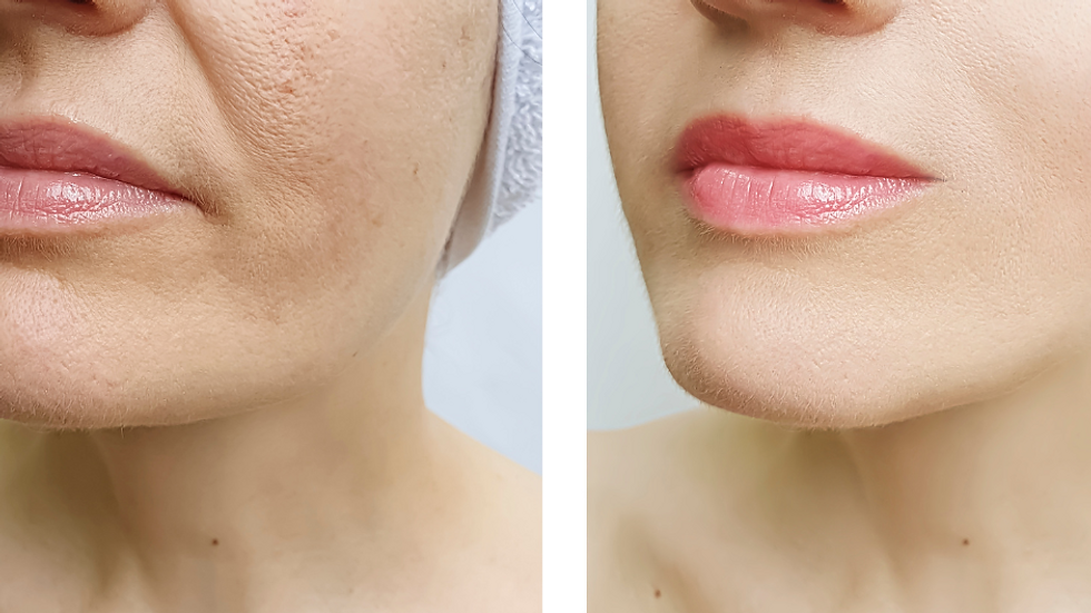 Understanding “Second Puberty” and How Beauty Quantum Aesthetics Can Help