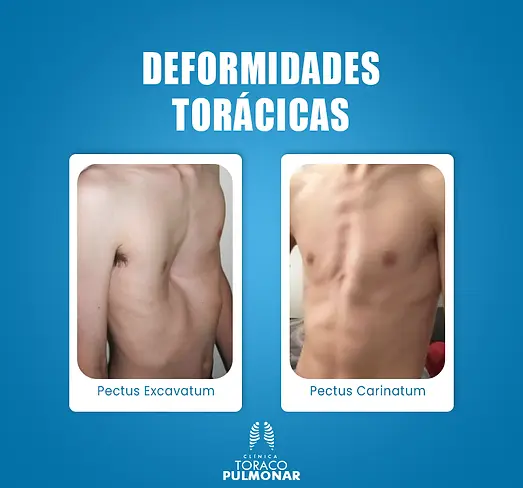 Deformidades Torácicas