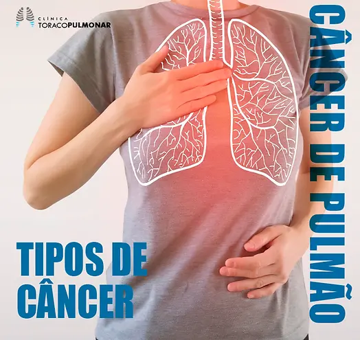 Câncer de Pulmão