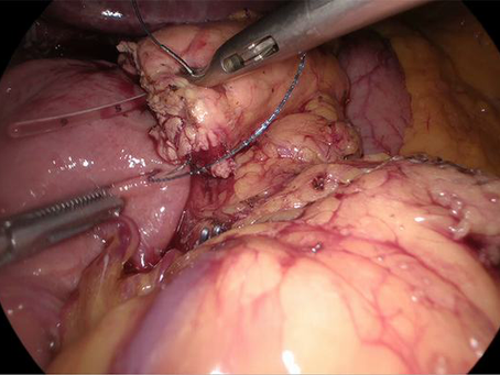 Is knotless pancreaticojejunostomy feasible? Is it safe? Can it be done laparoscopically?