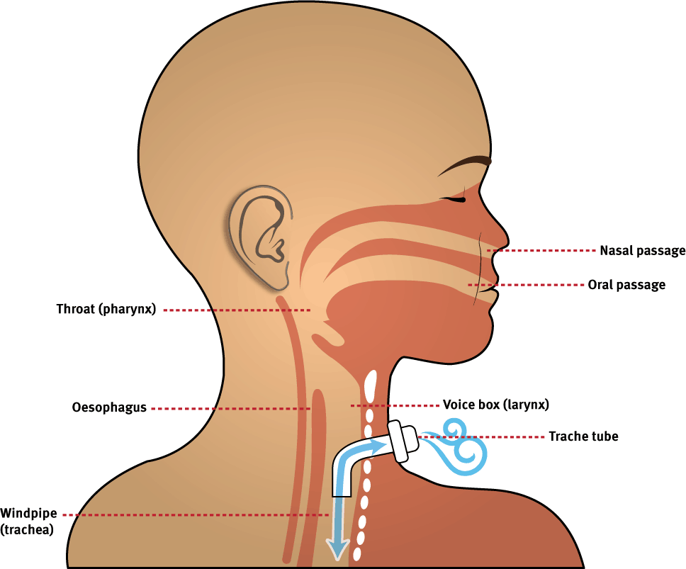 Life with a ventilator and tracheostomy