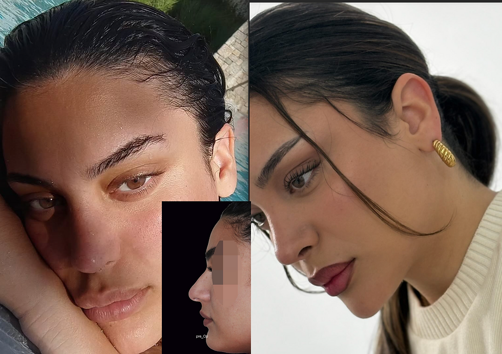 preservation , Tetris , Alar base reduction 4years post-op