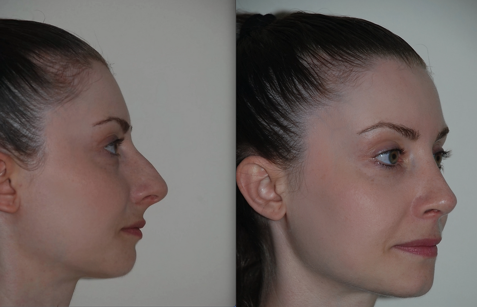 rhinoplasty domes modification, teostrut