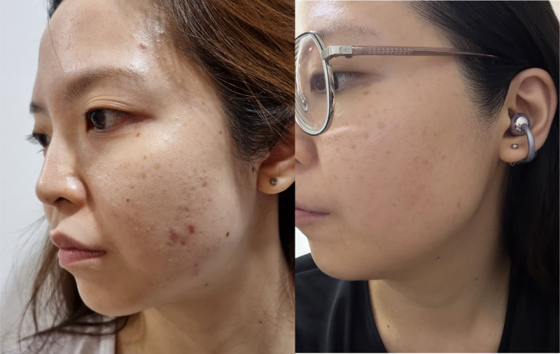 Before and after skin improvement using FitLine nutrition.