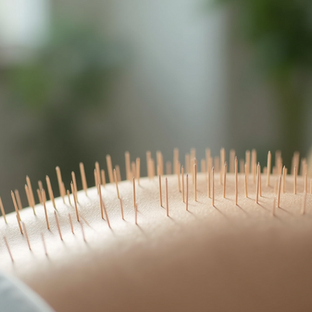 Exploring the Benefits of Acupuncture for Managing Sciatica Pain at Golden Way Clinic