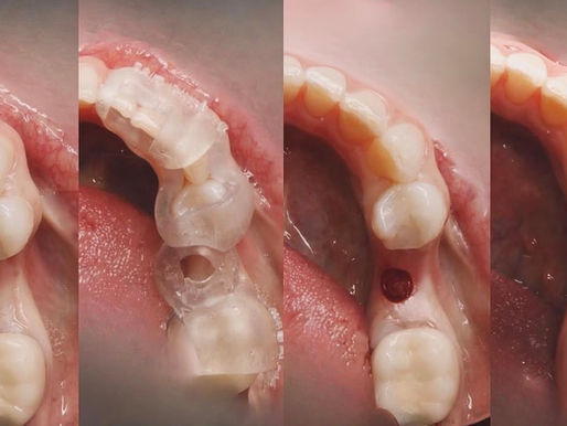 Implantes dentales, sin cirugía: LA PRECISION DE GUÍA QUIRÚRGICA