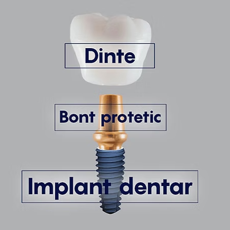 Structura implantului dentar