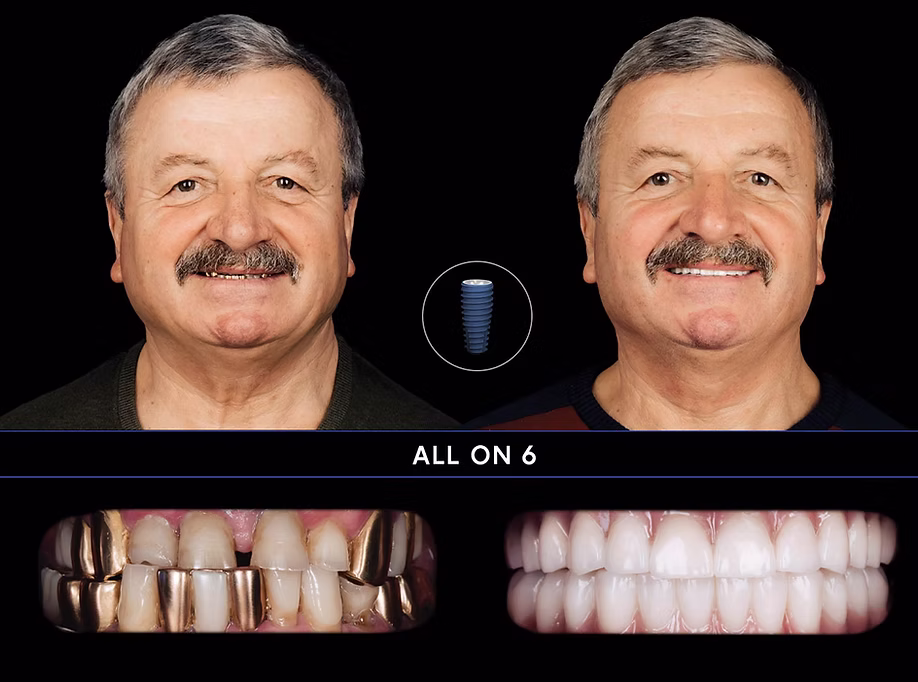 Rezultat before/after