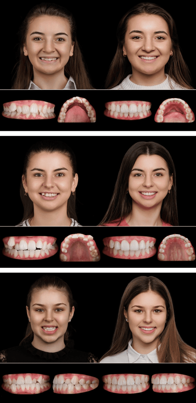 case study brackets.png