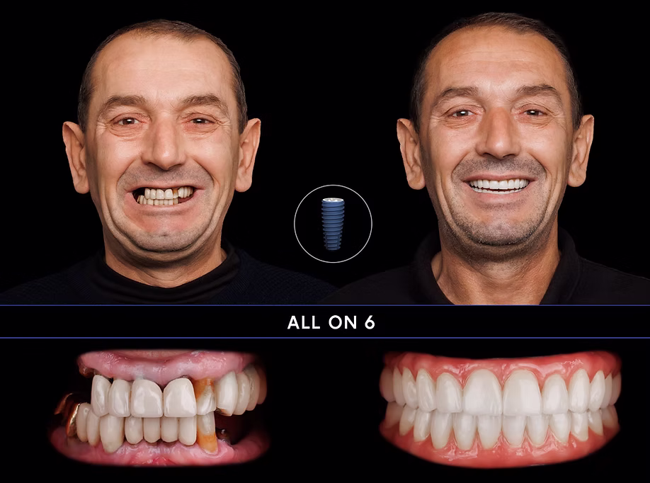 Rezultat before/after