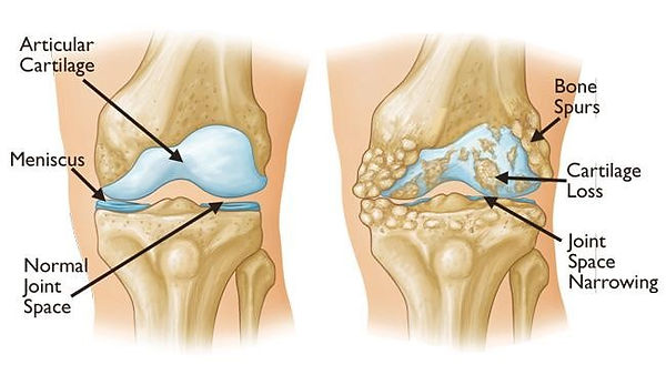 Knee-Osteo-Arthritis-Pain.jpg