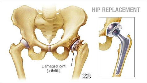 Hip-Replacement-1.png