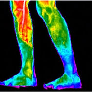 Infrared-image-of-the-medial-aspect-of-t